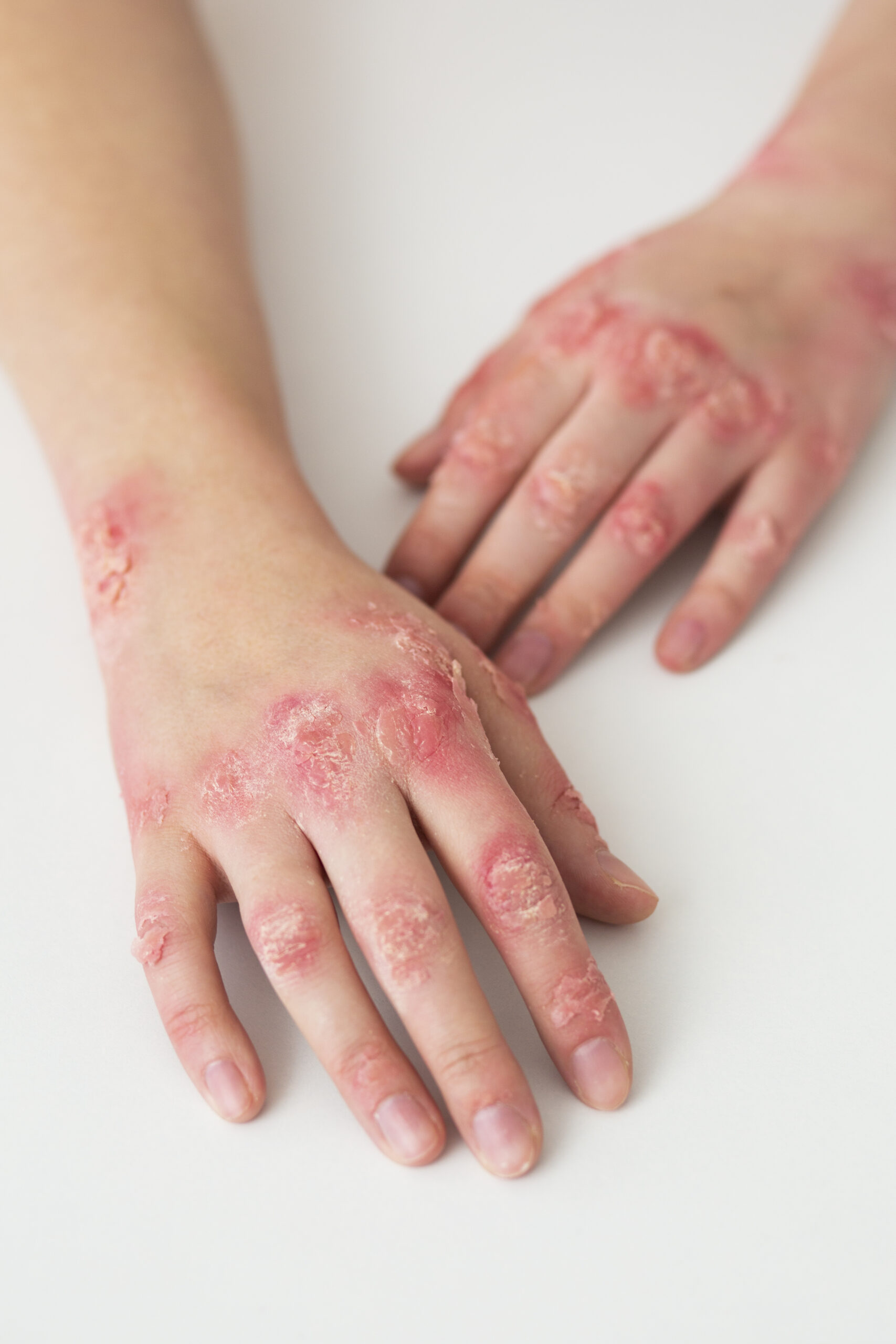 hands-patient-suffering-from-psoriasis